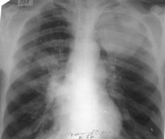 Рентгенологическая картина абсцесса лёгкого до его прорыва в бронх